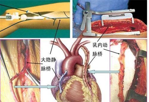 什么是冠状动脉搭桥术？十分钟的生死瞬间